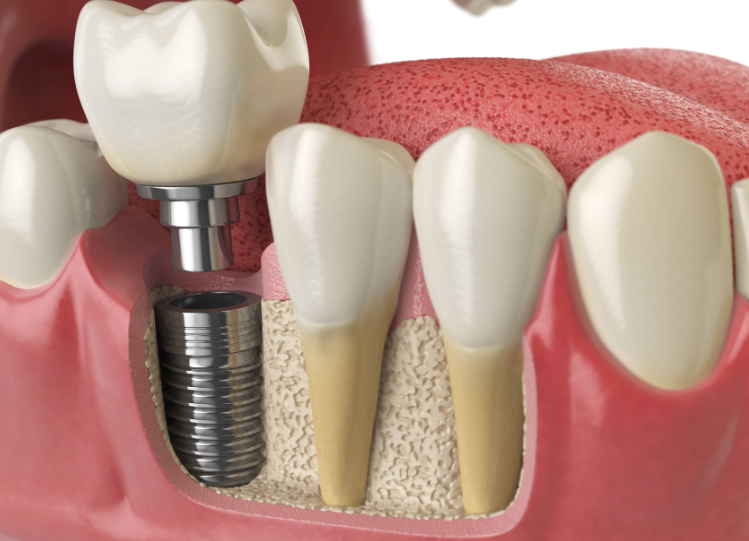 Mennyibe kerülnek a fogászati implantátumok?
